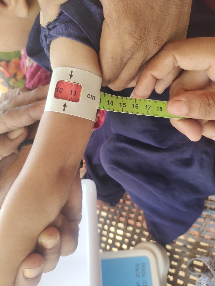 A health worker uses a Mid Upper Arm Circumference (MUAC) measurement to assess a child's severity of malnutrition